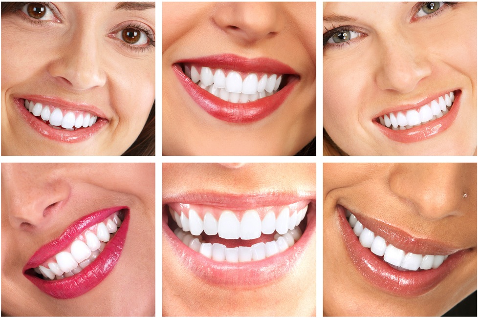 Teeth whitening by brighter image dental lab